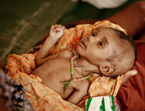 malnourished children