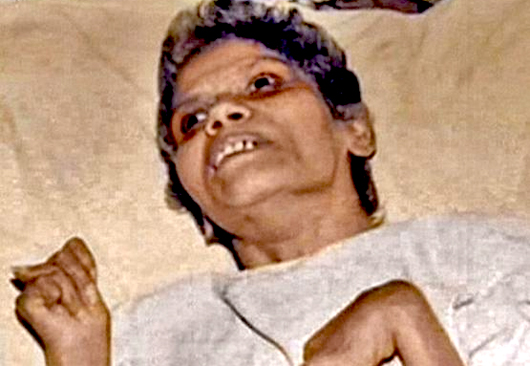 Aruna Shanbaug1