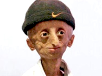 Progeria